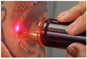 Tattoo-Removal-Laser_2