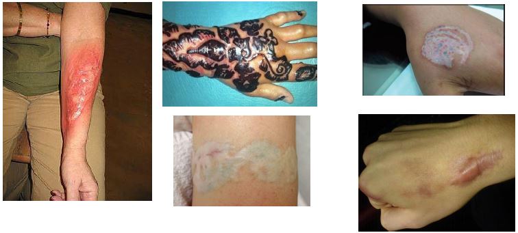 Tattoo-Removal-Laser_3