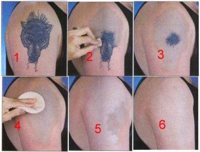 Tattoo-Removal-Natural_1