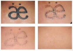 Q&A about Tattoo Removal - Self Tattoo Removal